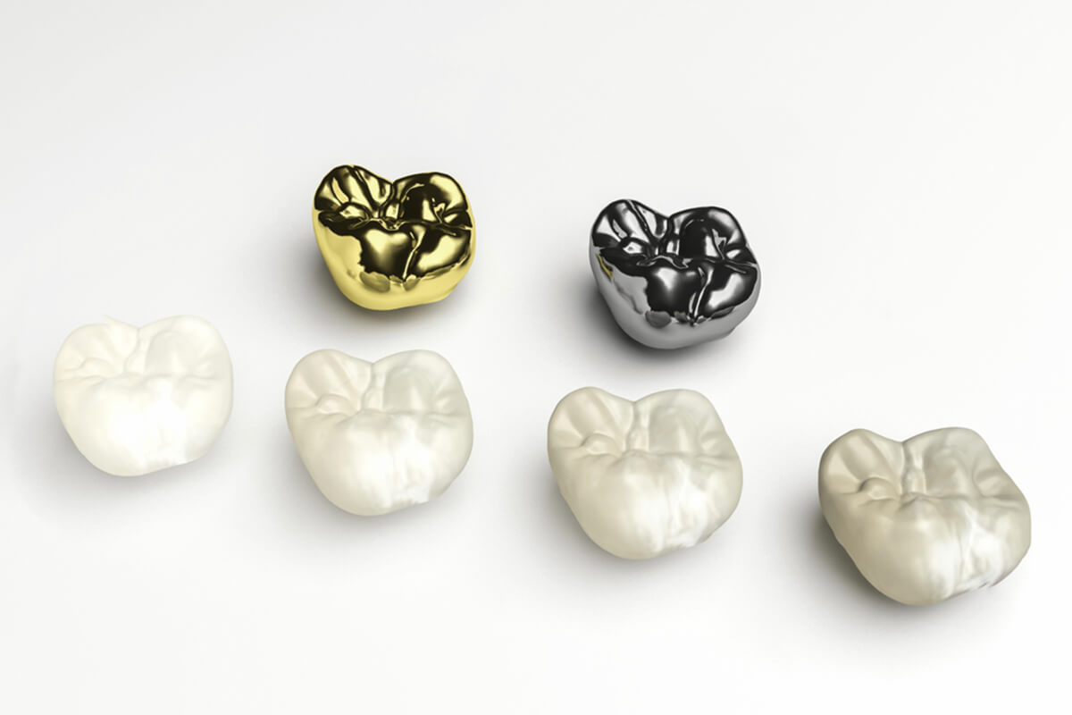 what steps are included in the procedure for dental crowns