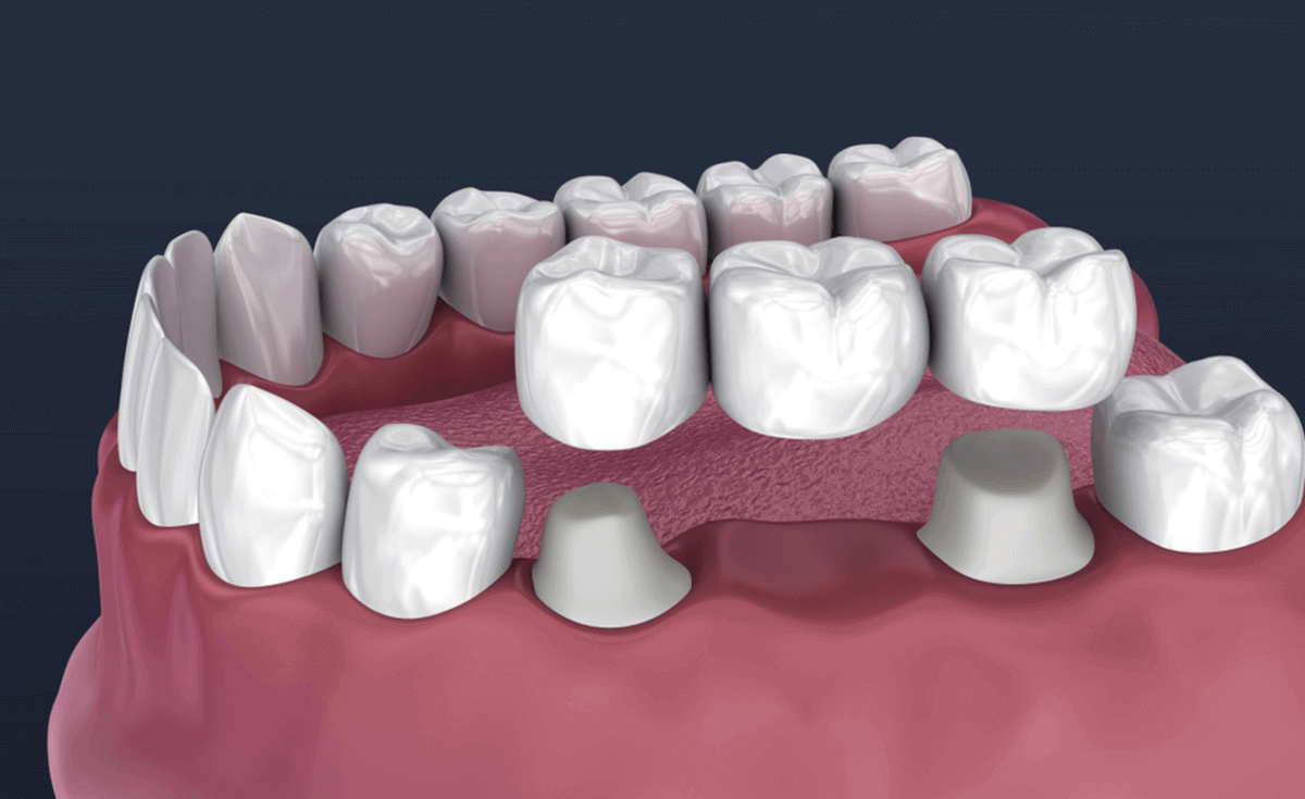 the benefits of dental bridges