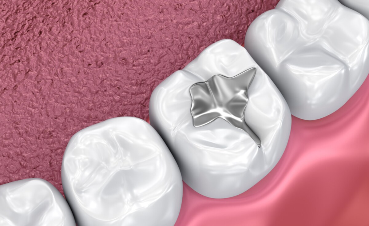 benefits of dental sealants